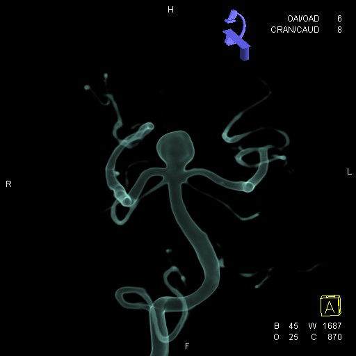 Aneurisma cerebral