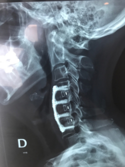 Columna vertebral cervical