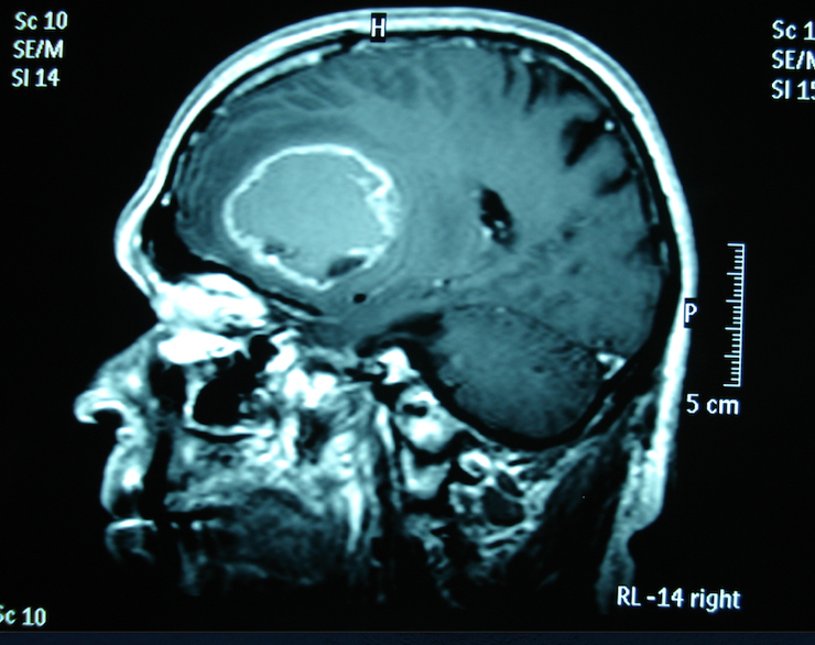 Glioblastoma