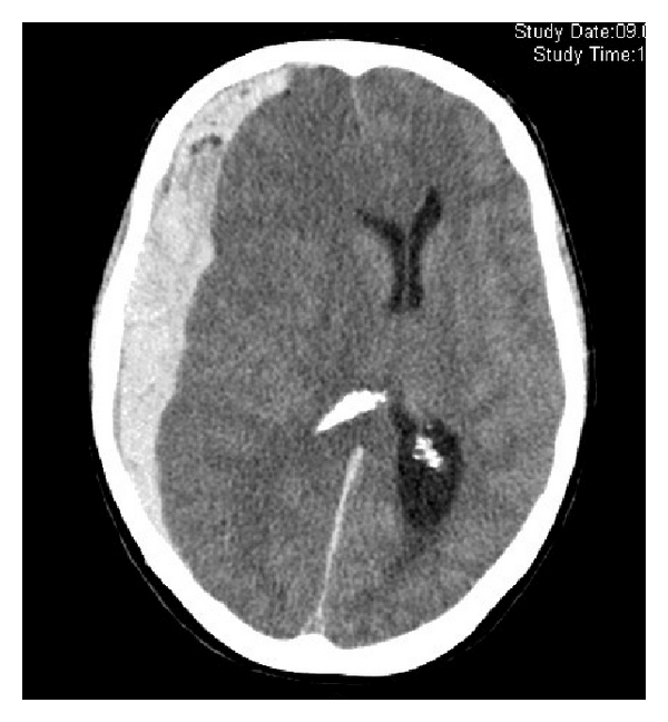 Hematoma subdural