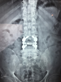 Columna vertebral lumbar