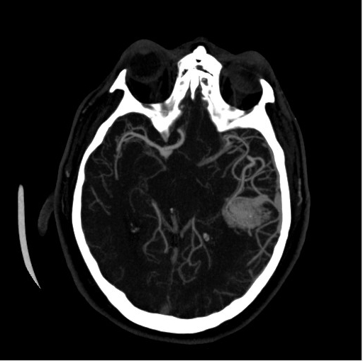 Malformación arteriovenosa